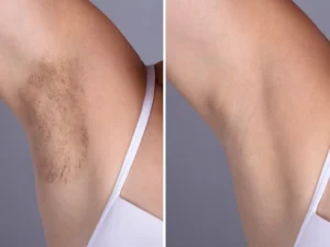 Electrolysis Laser hair removal in dubai