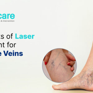 Laser Treatment for Varicose Veins