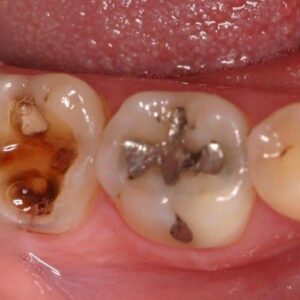 SMART – Dental Amalgam Removal