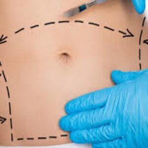 Tummy Tuck in Riyadh
