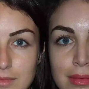 Rhinoplasty in Dubai