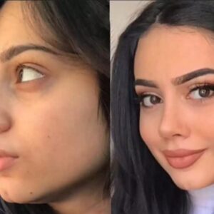 Septoplasty in Dubai