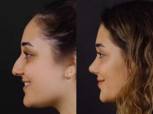 Rhinoplasty in Dubai