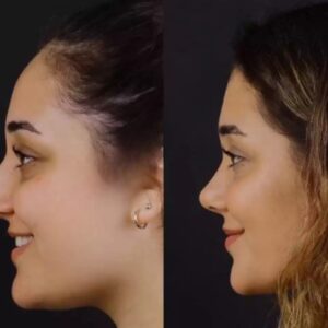 Rhinoplasty in Dubai