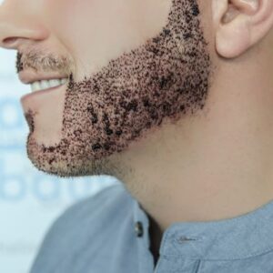 beard hair transplant in Islamabad
