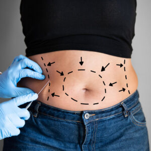 Liposuction for Stomach Fat: How It Works
