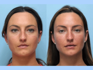 Restore Youthful, Radiant Skin with the Best Plastic Surgeons in Dubai for Thread Lift