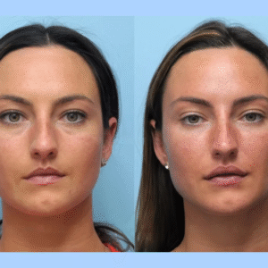 Restore Youthful, Radiant Skin with the Best Plastic Surgeons in Dubai for Thread Lift