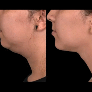 Double chin removal in Dubai
