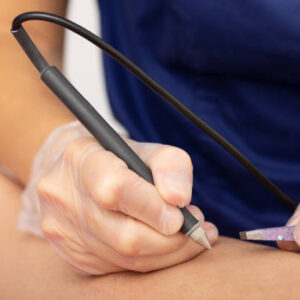 Cost Of Hair Removal By Eelectrolysis