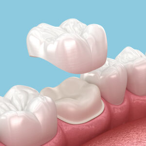 Dental Crowns and Bridges Dubai
