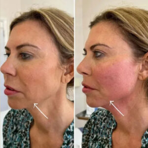 Best Aesthetic Clinic in Dubai on Collagen Boosting with Endolift