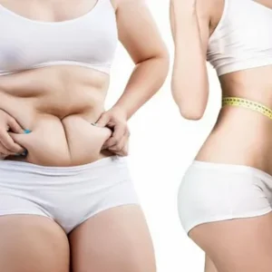 Liposuction in Riyadh